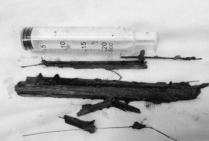 Cành cây dài 20cm nằm trong lồng ngực cụ bà suốt 2 năm.