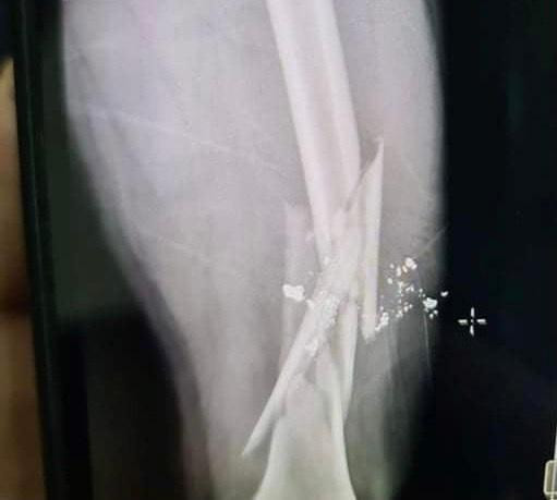 Phần đùi nạn nhân bị gãy sau khi bị Hoà dùng súng bắn.