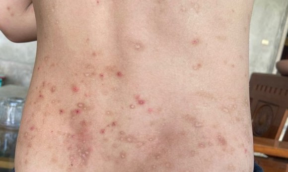 Nhiều người dân sau khi bị côn trùng đốt bị dị ứng da toàn cơ thể.