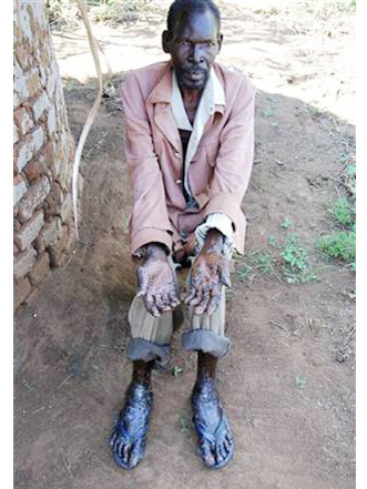 Bệnh nhân Anatoli Alemo 40 tuổi bị nhiễm bọ chét cát. Ảnh: AP