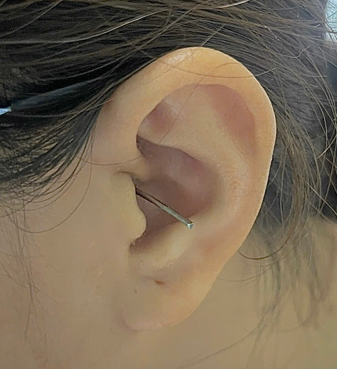 Nữ bệnh nhân nhập viện cùng với cây lấy ráy tai đã đâm thủng màng nhĩ