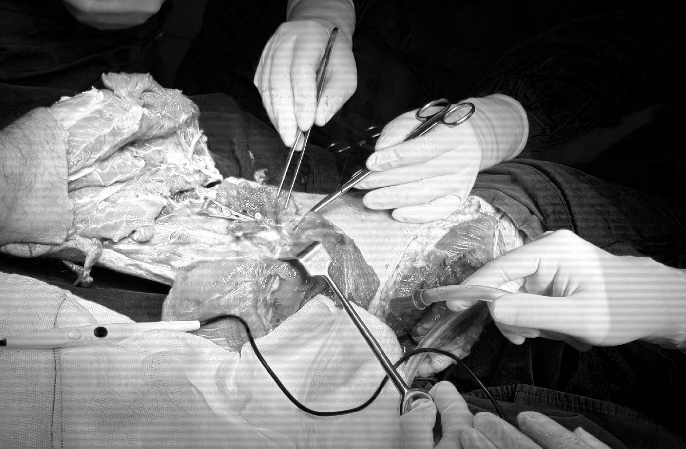 Các bác sĩ đã thực hiện cuộc vi phẫu nối thành công cẳng chân đứt lìa cho bệnh nhân