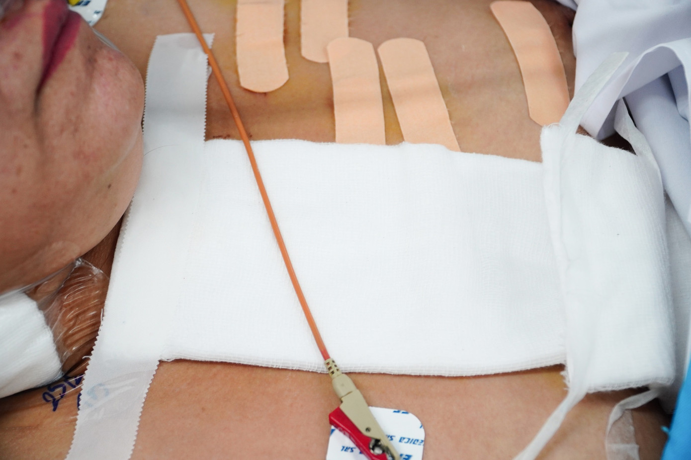 Những vết thương chi chít trên cơ thể người bệnh sau khi bị tấn công bằng dao Những vết thương chi chít trên cơ thể người bệnh sau khi bị tấn công bằng dao