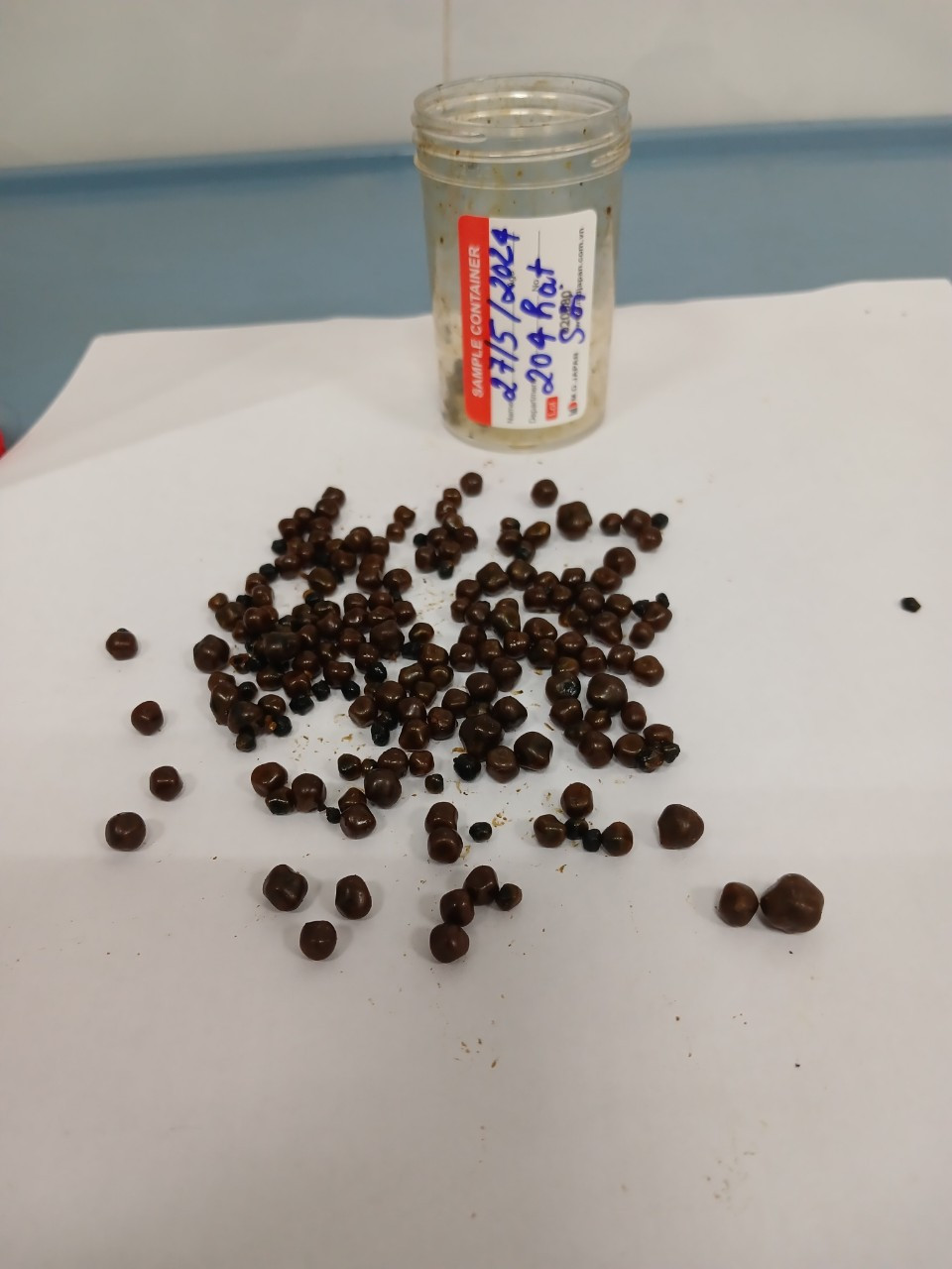 Một phần sỏi được các bác sĩ lấy ra từ đường mật của bệnh nhân Một phần sỏi được các bác sĩ lấy ra từ đường mật của bệnh nhân