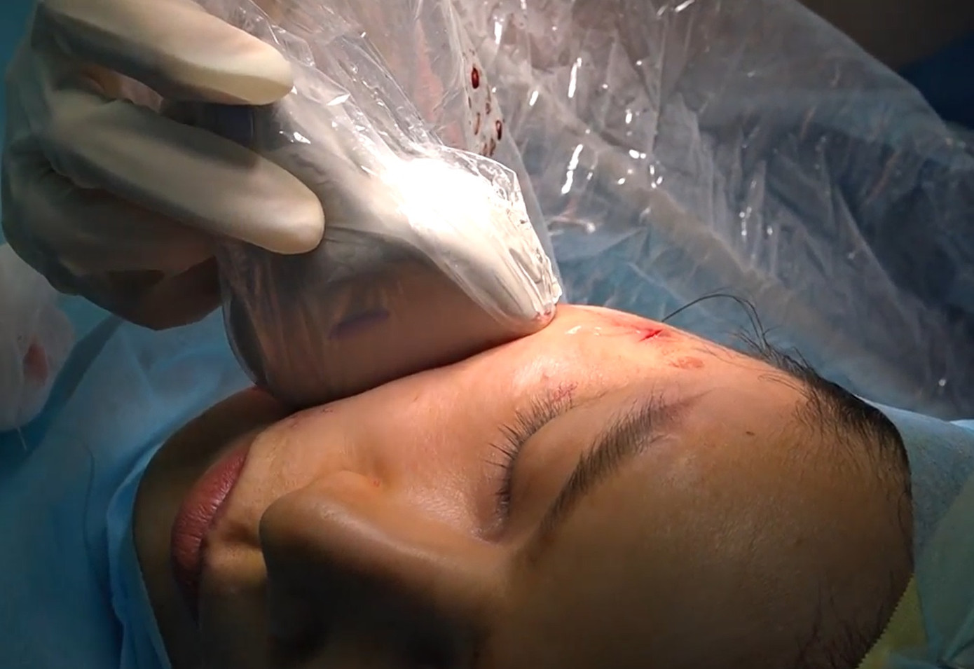 Nữ bệnh nhân bị hoại tử vùng mặt tạo ổ áp xe sau khi cấy chỉ làm đẹp Nữ bệnh nhân bị hoại tử vùng mặt tạo ổ áp xe sau khi cấy chỉ làm đẹp