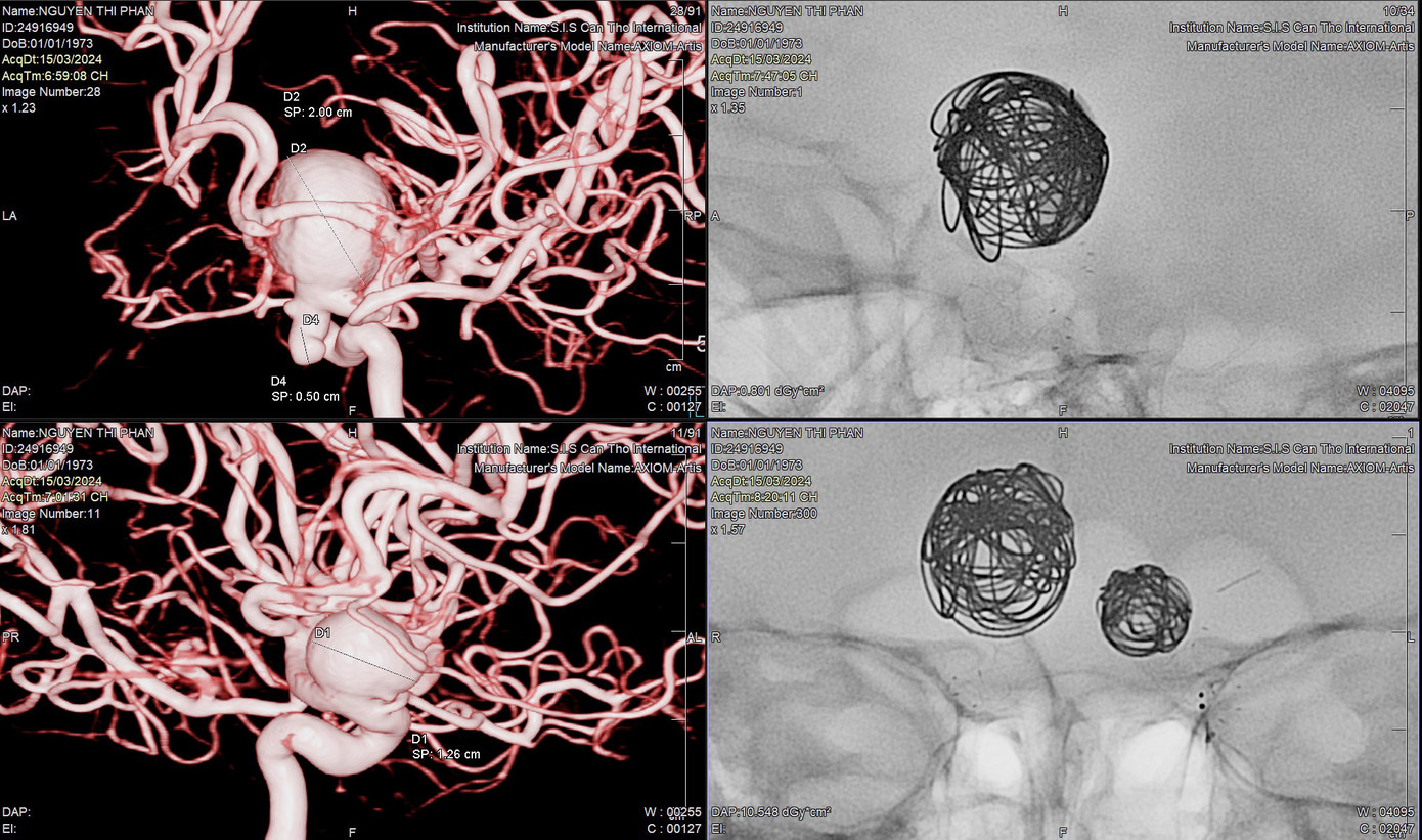 Bệnh nhân có 3 túi phình khổng lồ dọa vỡ đã được các bác sĩ can thiệp thành công (ảnh: BVCC) Bệnh nhân có 3 túi phình khổng lồ dọa vỡ đã được các bác sĩ can thiệp thành công (ảnh: BVCC)