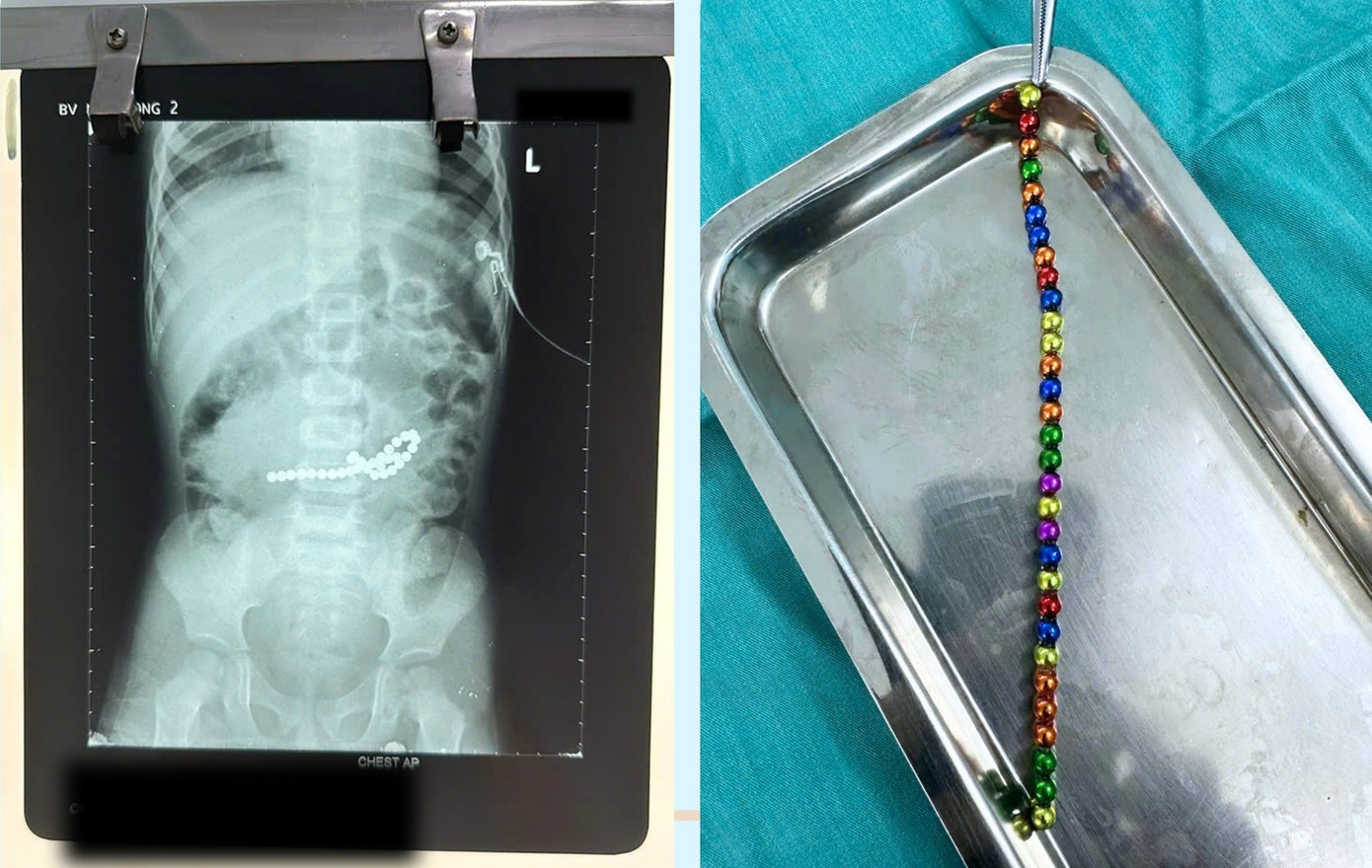 Các viên nam châm xếp hình trong đường tiêu hóa khiến trẻ bị thủng 8 lỗ ở ruột non