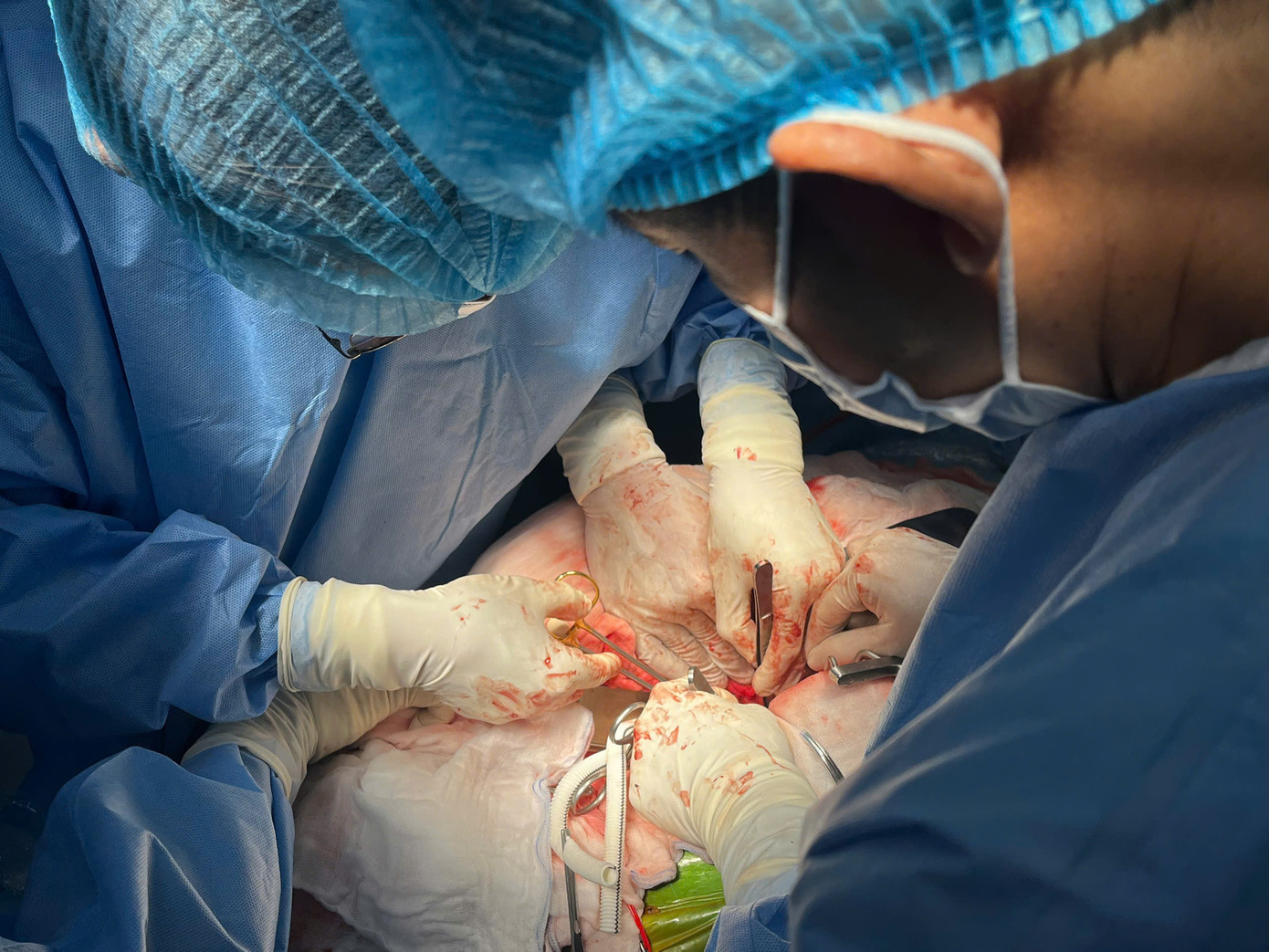 Các bác sĩ đã thay động mạch chủ bụng cứu bệnh nhân thoát cơn nguy kịch