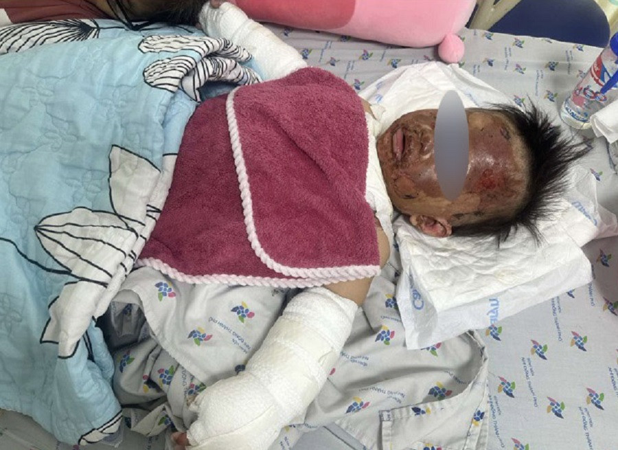 Bệnh nhi được chuyển đến cấp cứu tại Bệnh viện Nhi Đồng Thành Phố trong tình trạng bỏng nặng Bệnh nhi được chuyển đến cấp cứu tại Bệnh viện Nhi Đồng Thành Phố trong tình trạng bỏng nặng