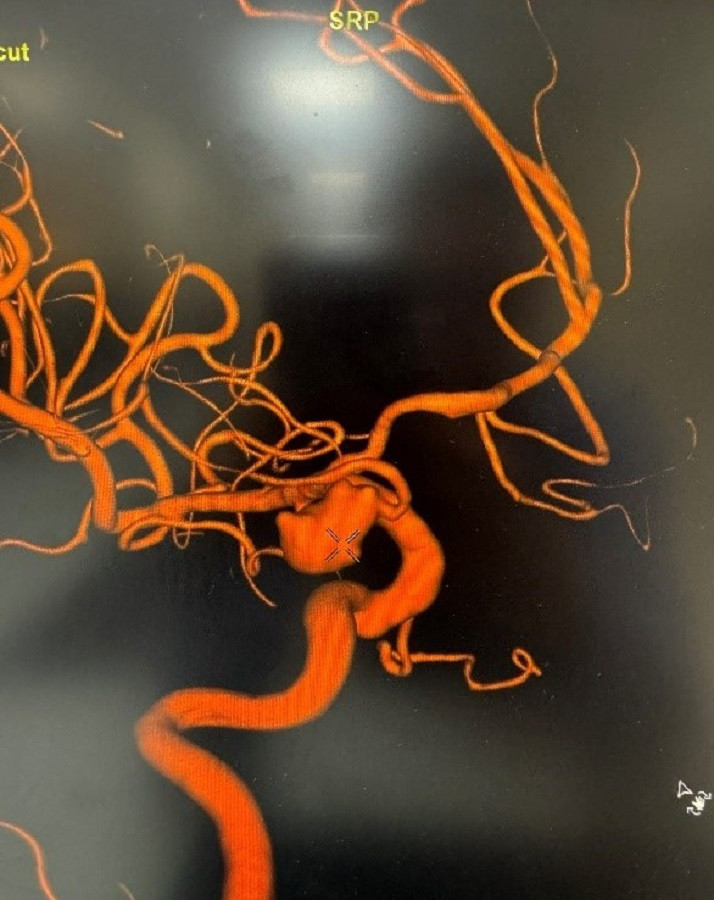 Không kiểm soát được huyết áp dẫn tới phình và vỡ mạch máu não là nguyên nhân khiến bệnh nhân bị đột quỵ Không kiểm soát được huyết áp dẫn tới phình và vỡ mạch máu não là nguyên nhân khiến bệnh nhân bị đột quỵ