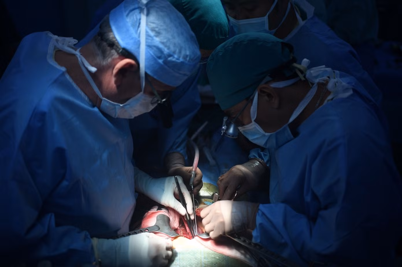 Các bác sĩ đã thực hiện thành công cuộc ghép gan đầu tiên trên bệnh nhi bị hội chứng Budd Chiari tại Việt Nam