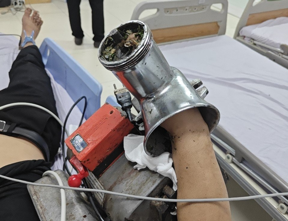 Nạn nhân được chuyển đến cấp cứu cùng chiếc máy xay thịt vì bàn tay bị kẹt trong cối xay