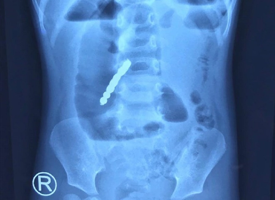 Mỗi năm, tại Bệnh viện Nhi Đồng 2 tiếp nhận khoảng 10 trường hợp trẻ nuốt nam châm đồ chơi Mỗi năm, tại Bệnh viện Nhi Đồng 2 tiếp nhận khoảng 10 trường hợp trẻ nuốt nam châm đồ chơi