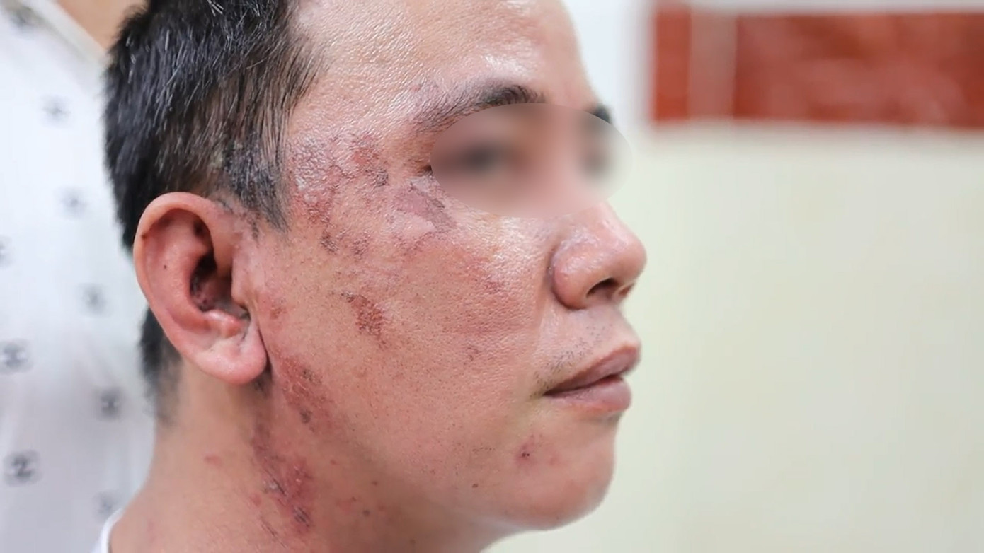 Một trường hợp bị tổn thương vùng đầu mặt do độc tố của kiến ba khoang gây ra Một trường hợp bị tổn thương vùng đầu mặt do độc tố của kiến ba khoang gây ra