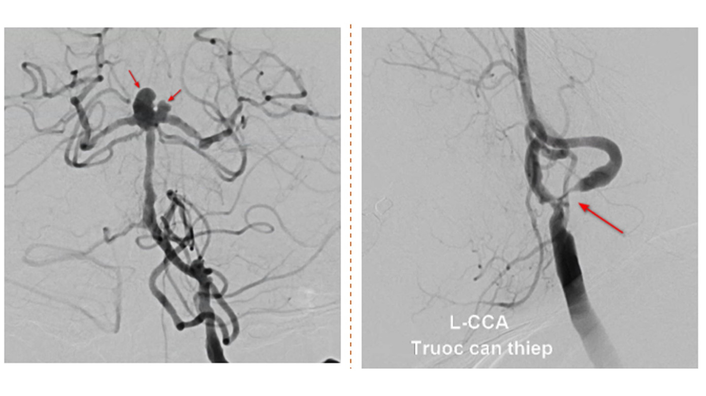 Bệnh nhân vừa bị hẹp mạch máu (hình bên phải) dẫn tới nhồi máu não vừa bị phình mạch máu (hình bên trái) nguy cơ xuất huyết não Bệnh nhân vừa bị hẹp mạch máu (hình bên phải) dẫn tới nhồi máu não vừa bị phình mạch máu (hình bên trái) nguy cơ xuất huyết não