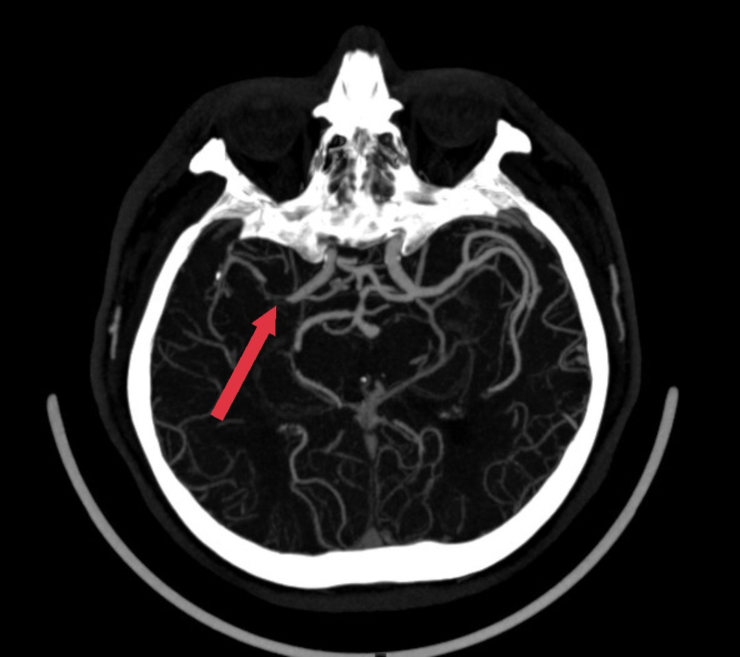 Một bên động mạch não của bệnh nhân bị tắc hoàn toàn thời điểm nhập viện cấp cứu