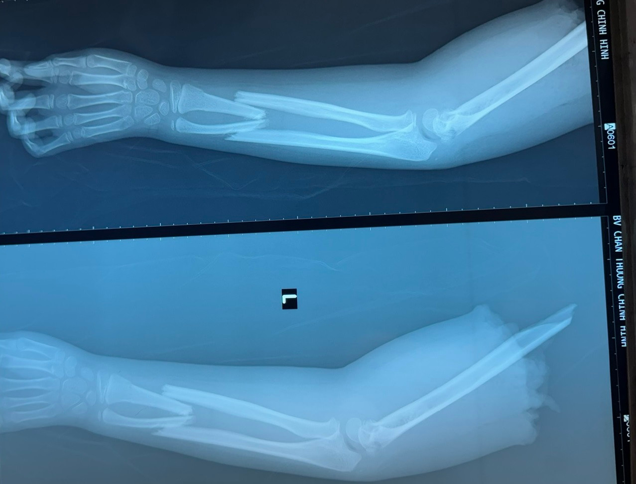 Cánh tay của bệnh nhi bị đứt lìa thời điểm nhập viện cấp cứu