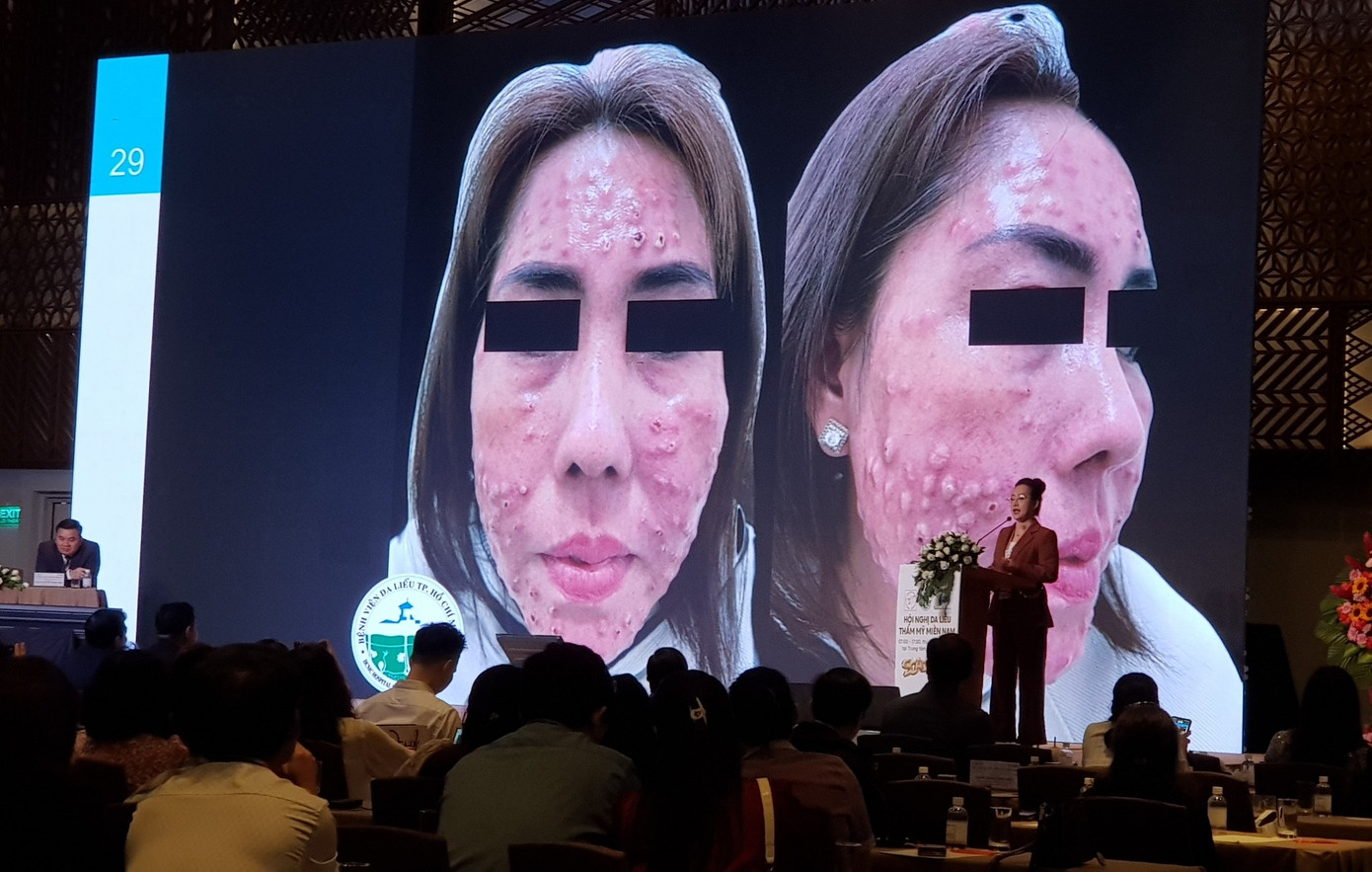 Một trường hợp bị tai biến thẩm mỹ nghiêm trọng được BS Phan Thúy báo cáo tại hội nghị Một trường hợp bị tai biến thẩm mỹ nghiêm trọng được BS Phan Thúy báo cáo tại hội nghị