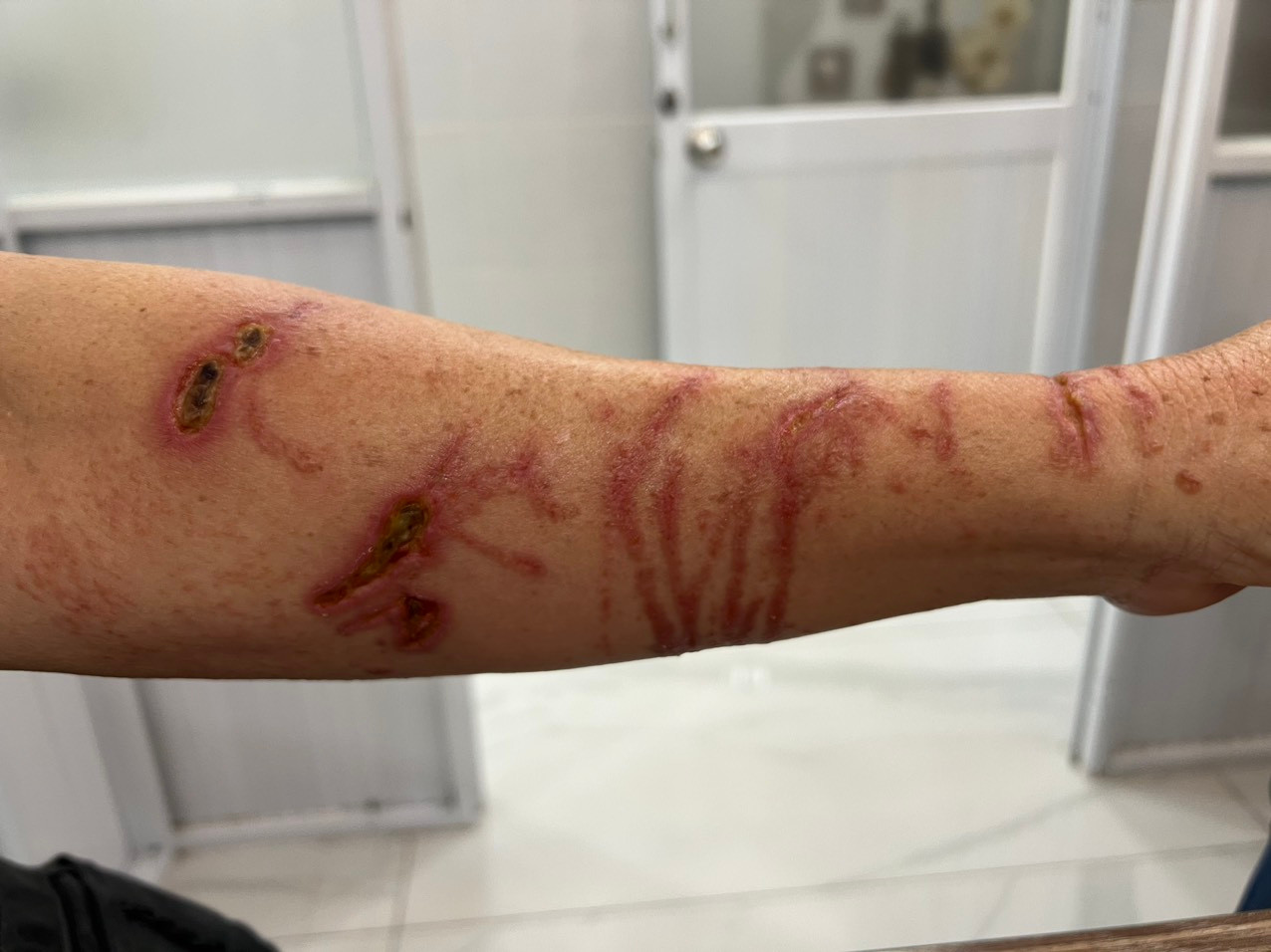 Cánh tay bệnh nhân bị tổn thương nghiêm trọng do sứa biển gây ra Cánh tay bệnh nhân bị tổn thương nghiêm trọng do sứa biển gây ra