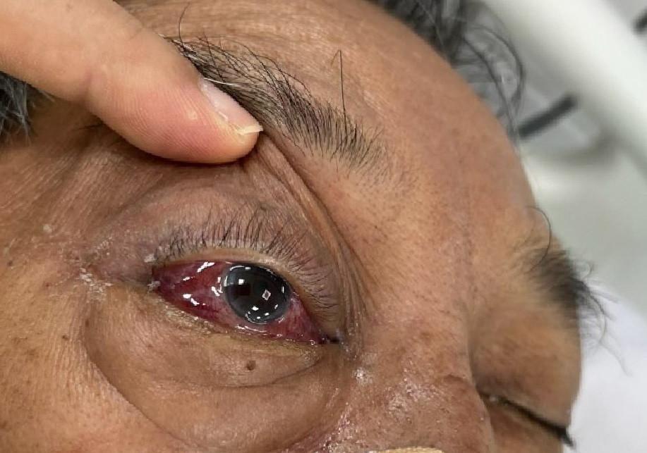 Bệnh nhân nhập viện trong tình trạng đỏ mắt, ù tai rồi rơi vào hôn mê