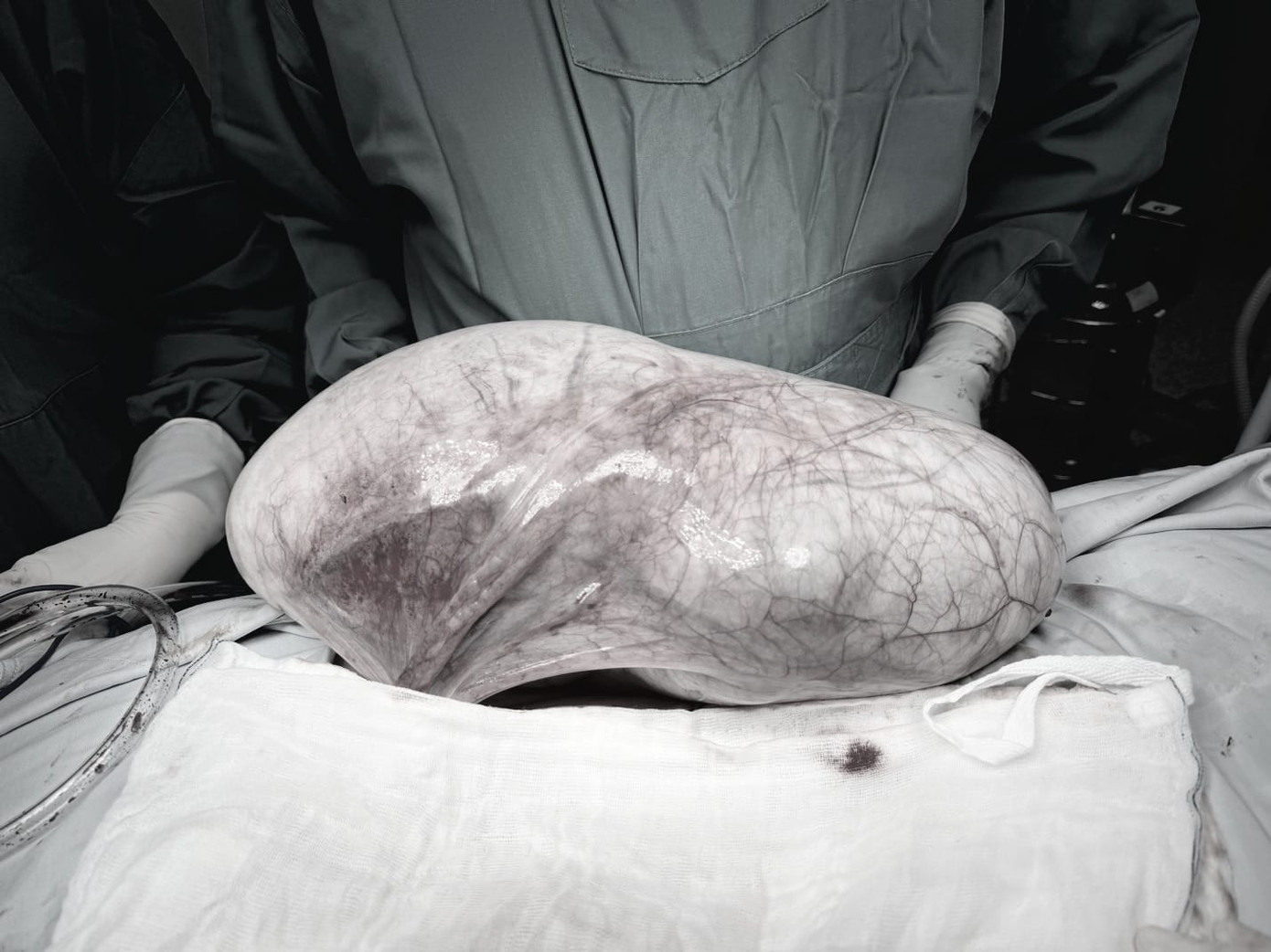 Khối u buồng trứng nặng 12kg được ê kíp phẫu thuật bóc tách thành công Khối u buồng trứng nặng 12kg được ê kíp phẫu thuật bóc tách thành công