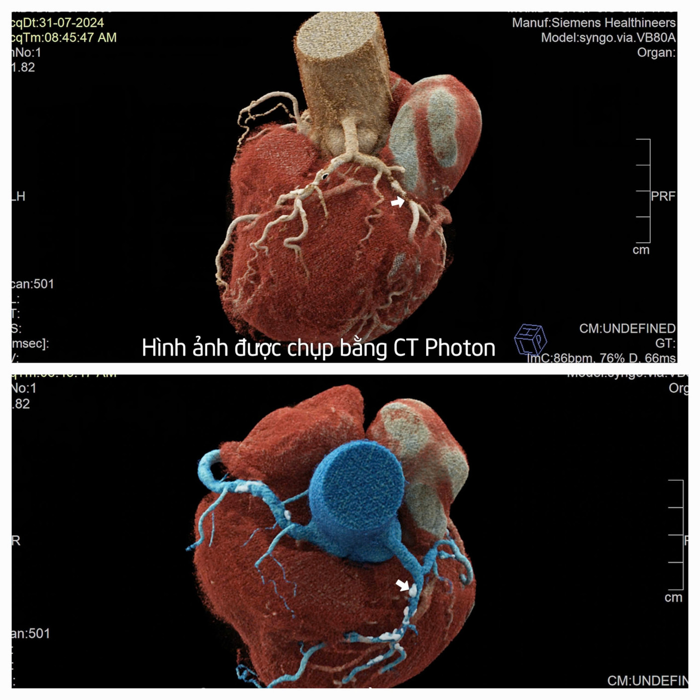 Hình ảnh chụp CT Photon phát hiện bệnh nhân bị tắc nghẽn 2 nhánh mạch vành (vị trí mũi tên)