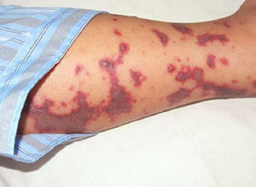 Tình trạng phát ban hình bản đồ trên da của người bệnh mắc não mô cầu (ảnh minh họa)