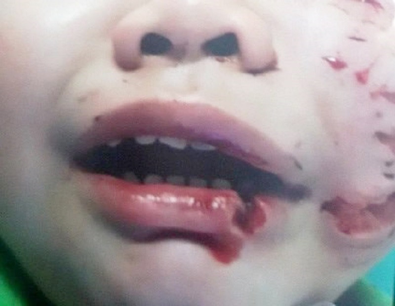 Một trường hợp trẻ bị chó cắn đến cấp cứu tại Bệnh viện Nhi Đồng 1 TPHCM (ảnh: BSCC) Một trường hợp trẻ bị chó cắn đến cấp cứu tại Bệnh viện Nhi Đồng 1 TPHCM (ảnh: BSCC)