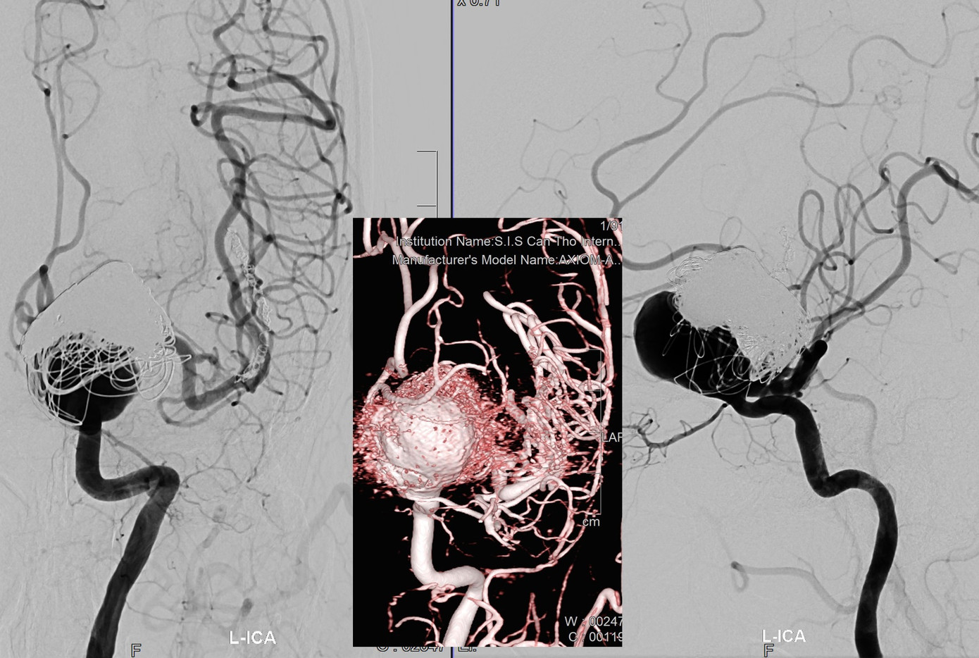Túi phình khổng lồ trong não nguy cơ vỡ khiến bệnh nhân tử vong bất kỳ lúc nào