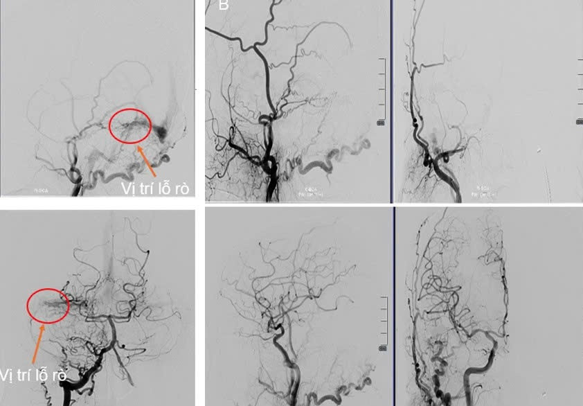Hình ảnh mạch máu não của người bệnh trước (ảnh bên trái) và sau khi can thiệp