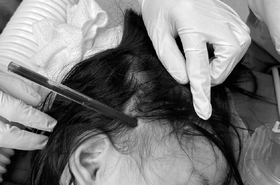 Cây bút bi ghim vào vùng thái dương bên phải của bé tại thời điểm nhập viện cấp cứu Cây bút bi ghim vào vùng thái dương bên phải của bé tại thời điểm nhập viện cấp cứu