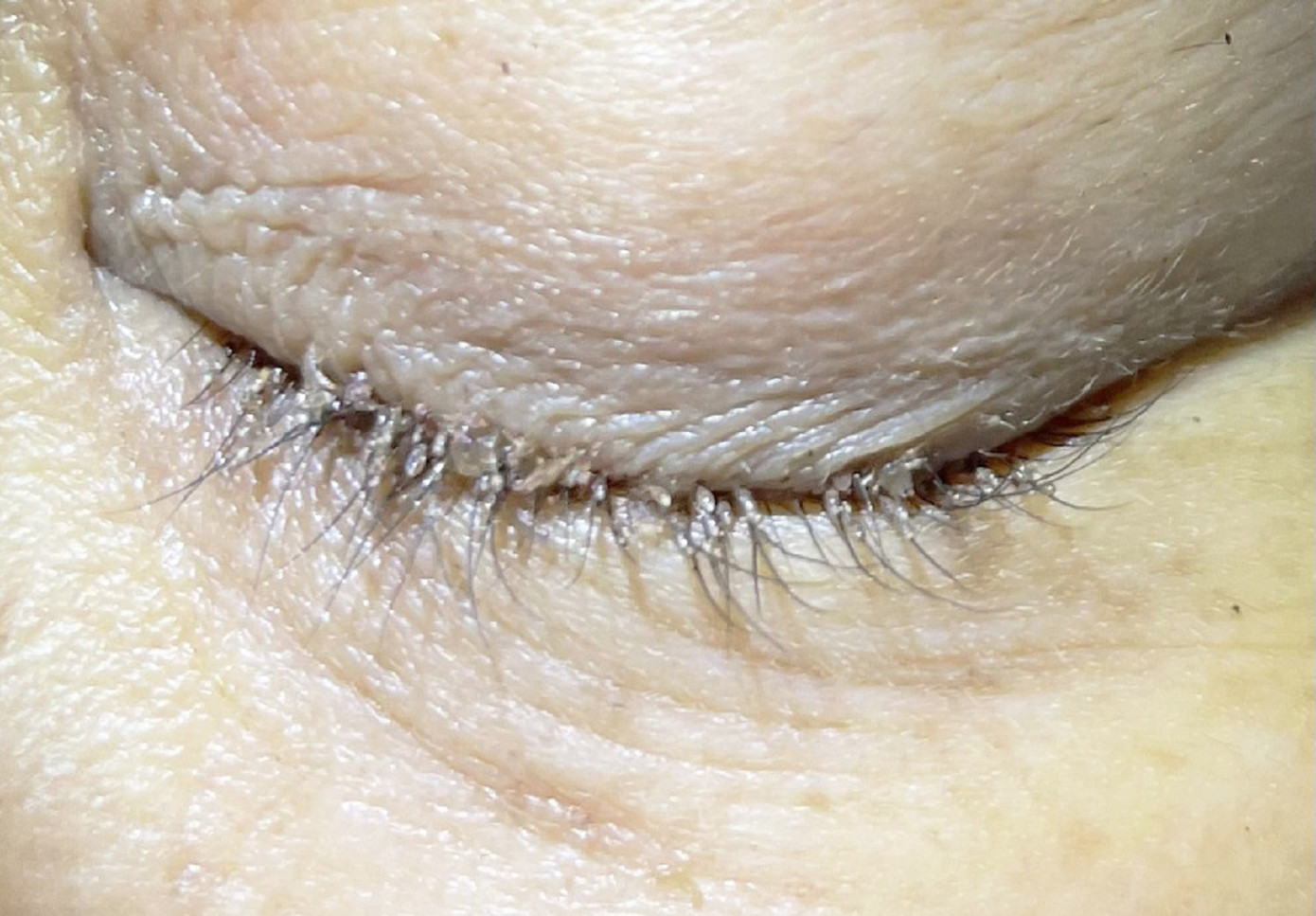 Bầy rận mu đã ký sinh trên mí mắt và đẻ trứng trên lông mi của bệnh nhân