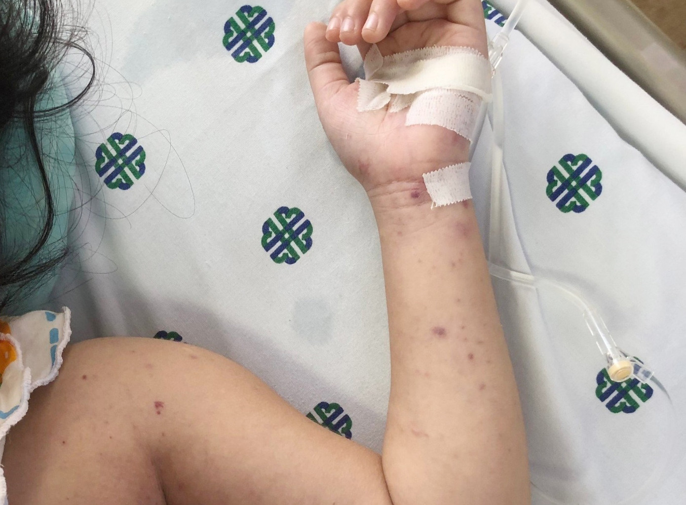 Những vùng ban đỏ nổi lên trên cơ thể bệnh nhi bị viêm não mô cầu