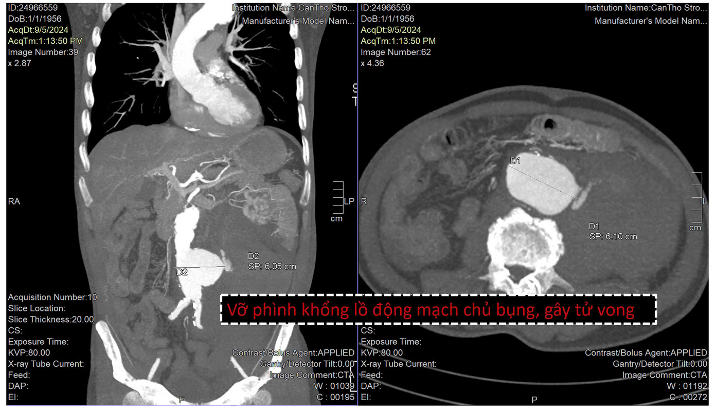 Túi phình động mạch chủ bụng bị vỡ là nguyên nhân khiến người bệnh tử vong