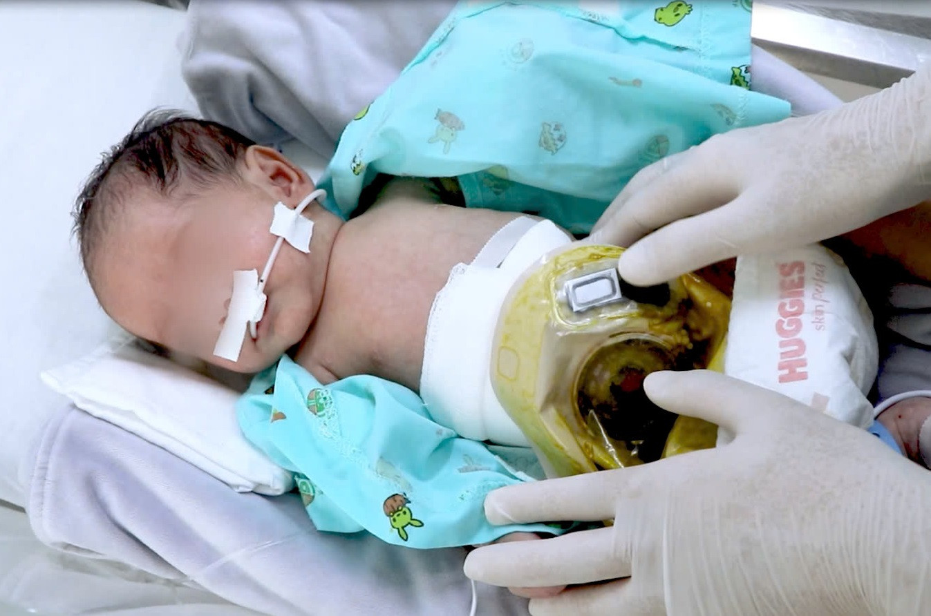 Sau phẫu thuật, bệnh nhi đã được làm hậu môn nhân tạo và đang được tiếp tục điều trị Sau phẫu thuật, bệnh nhi đã được làm hậu môn nhân tạo và đang được tiếp tục điều trị