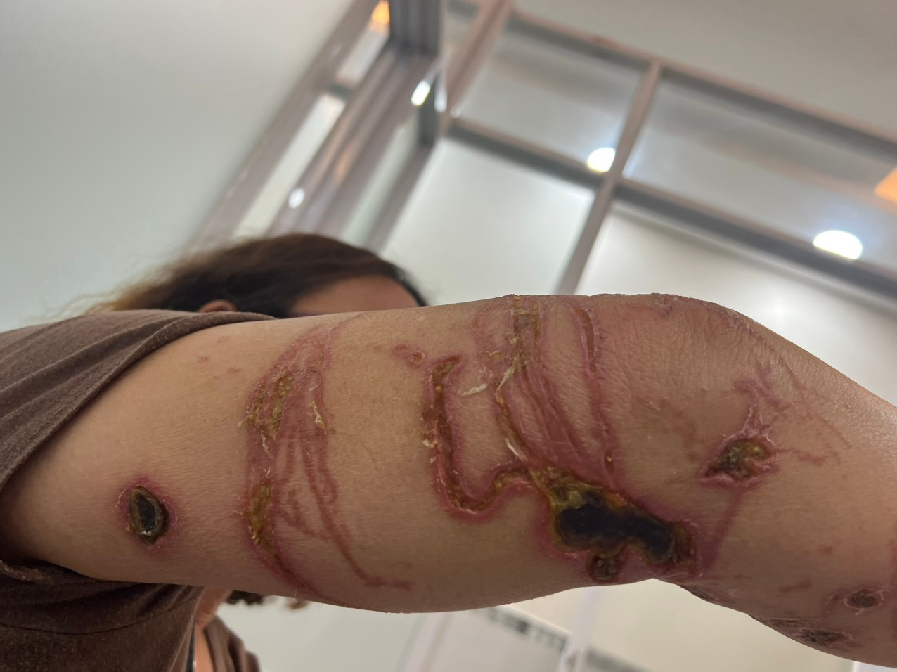 Những vị trí bị hoại tử sâu trên cơ thể bệnh nhân sau khi bị sứa lửa tấn công Những vị trí bị hoại tử sâu trên cơ thể bệnh nhân sau khi bị sứa lửa tấn công