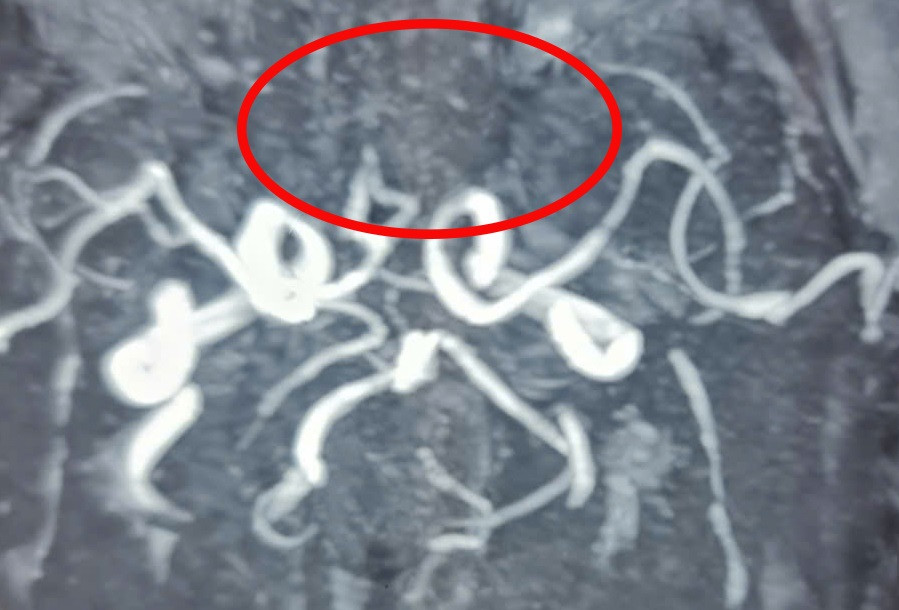 Hình ảnh MRI ghi nhận vị trí bị tắc mạch máu não ở người bệnh thời điểm nhập viện