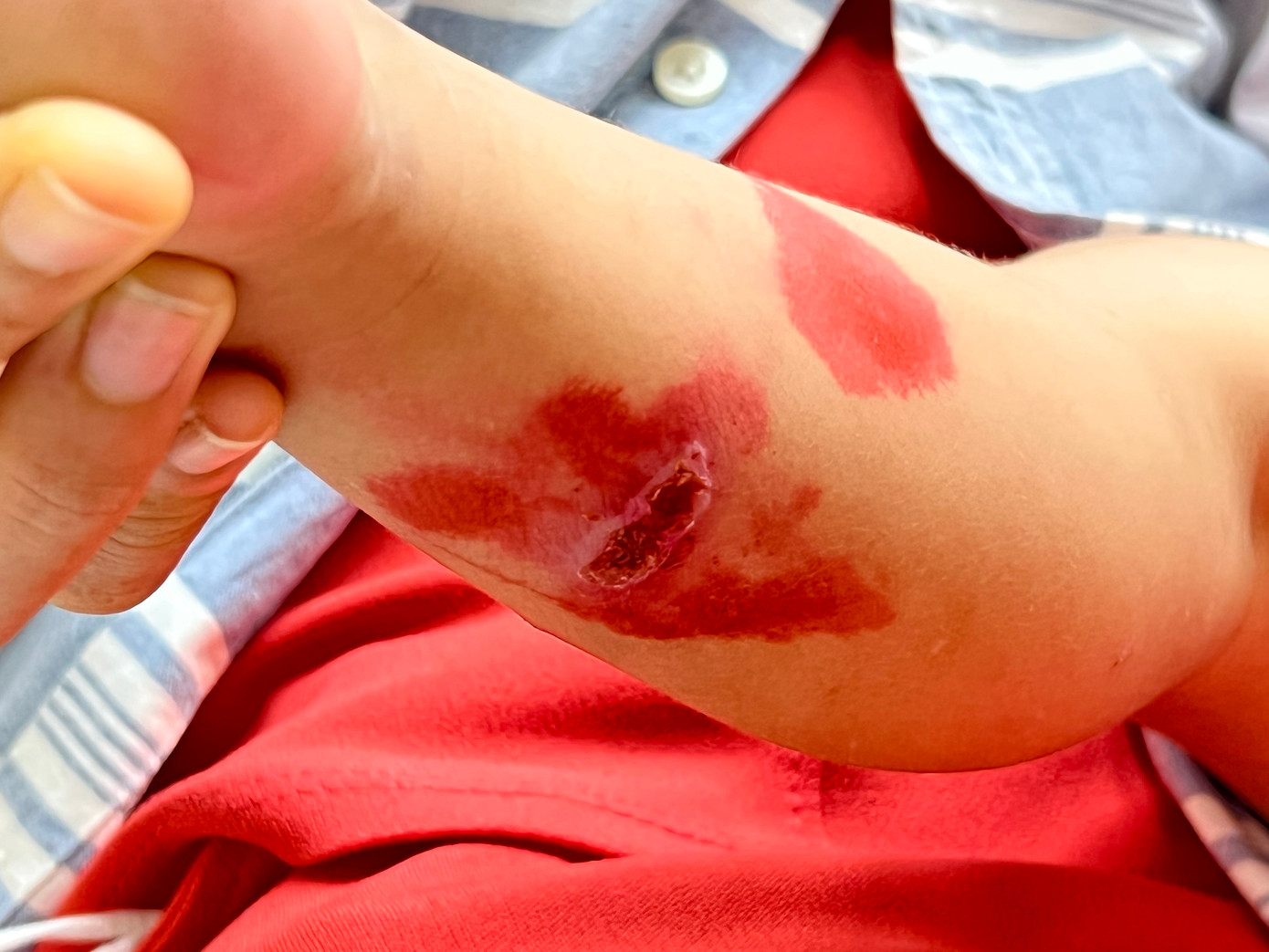 Vết thương ở trẻ bị bệnh chốc lở đến khám tại Bệnh viện Da Liễu TPHCM Vết thương ở trẻ bị bệnh chốc lở đến khám tại Bệnh viện Da Liễu TPHCM