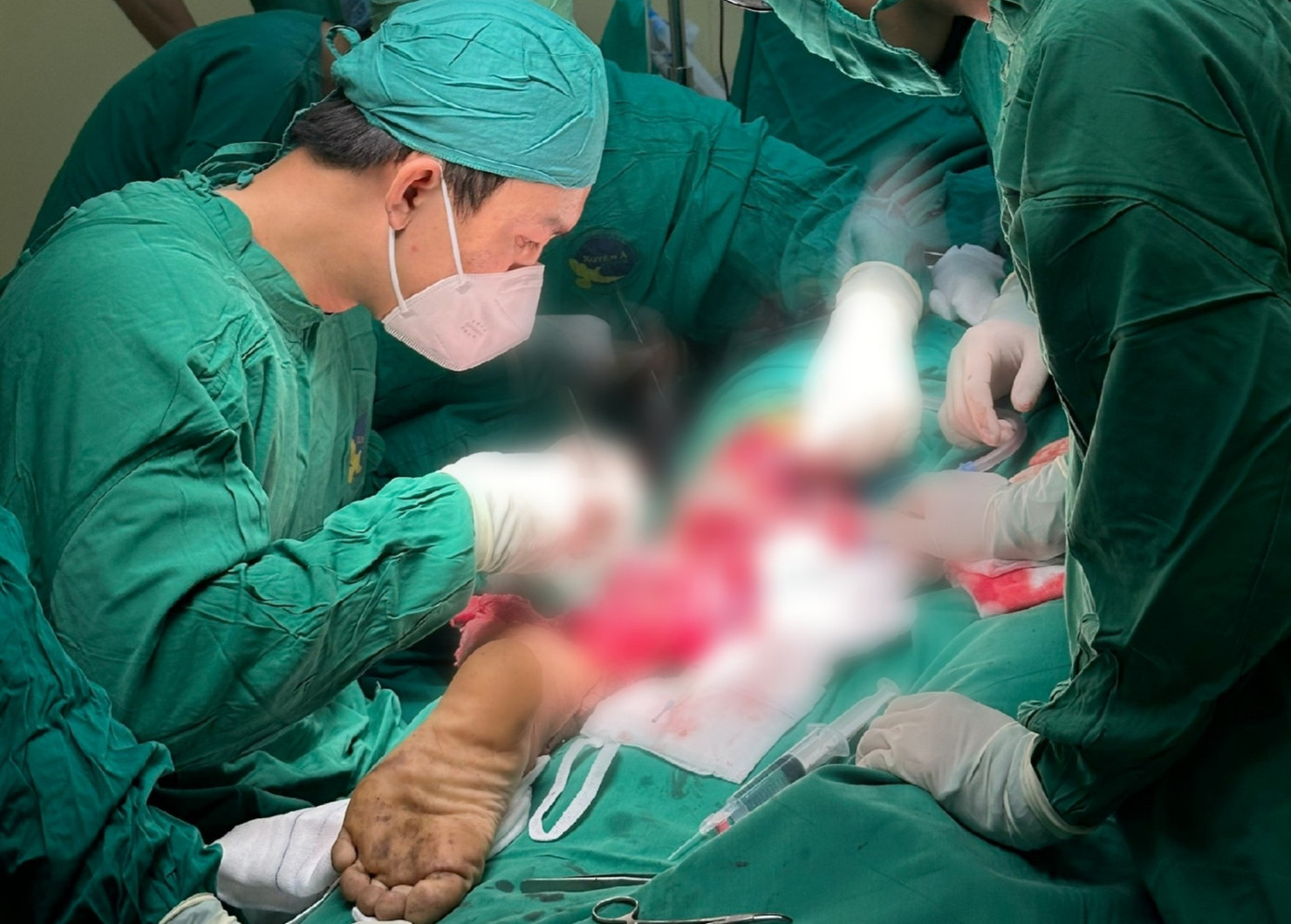 Bệnh nhân nhập viện trong tình trạng cẳng chân trái bị đứt lìa hoàn toàn sau tai nạn lao động