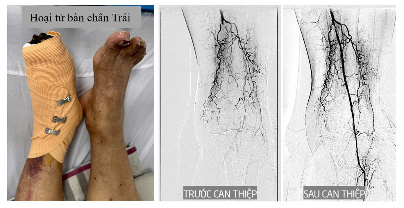 Bàn chân trái bị hoại tử cùng hình ảnh mạch máu người bệnh trước và sau can thiệp