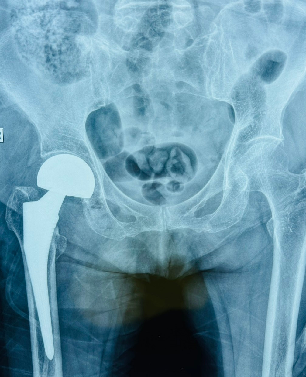 Người bệnh lớn tuổi được thay cổ xương đùi bán phần giúp phục hồi vận động