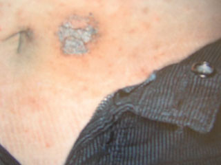 Một trường hợp bị viêm da do tiếp xúc. Ảnh: K.V . Một trường hợp bị viêm da do tiếp xúc. Ảnh: K.V