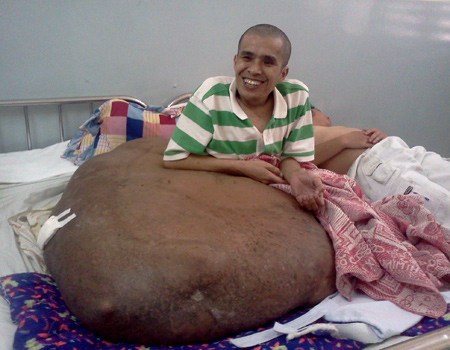 Dù khó khăn nhưng anh Hải vẫn mong mỏi được mổ tách khối u khổng lồ