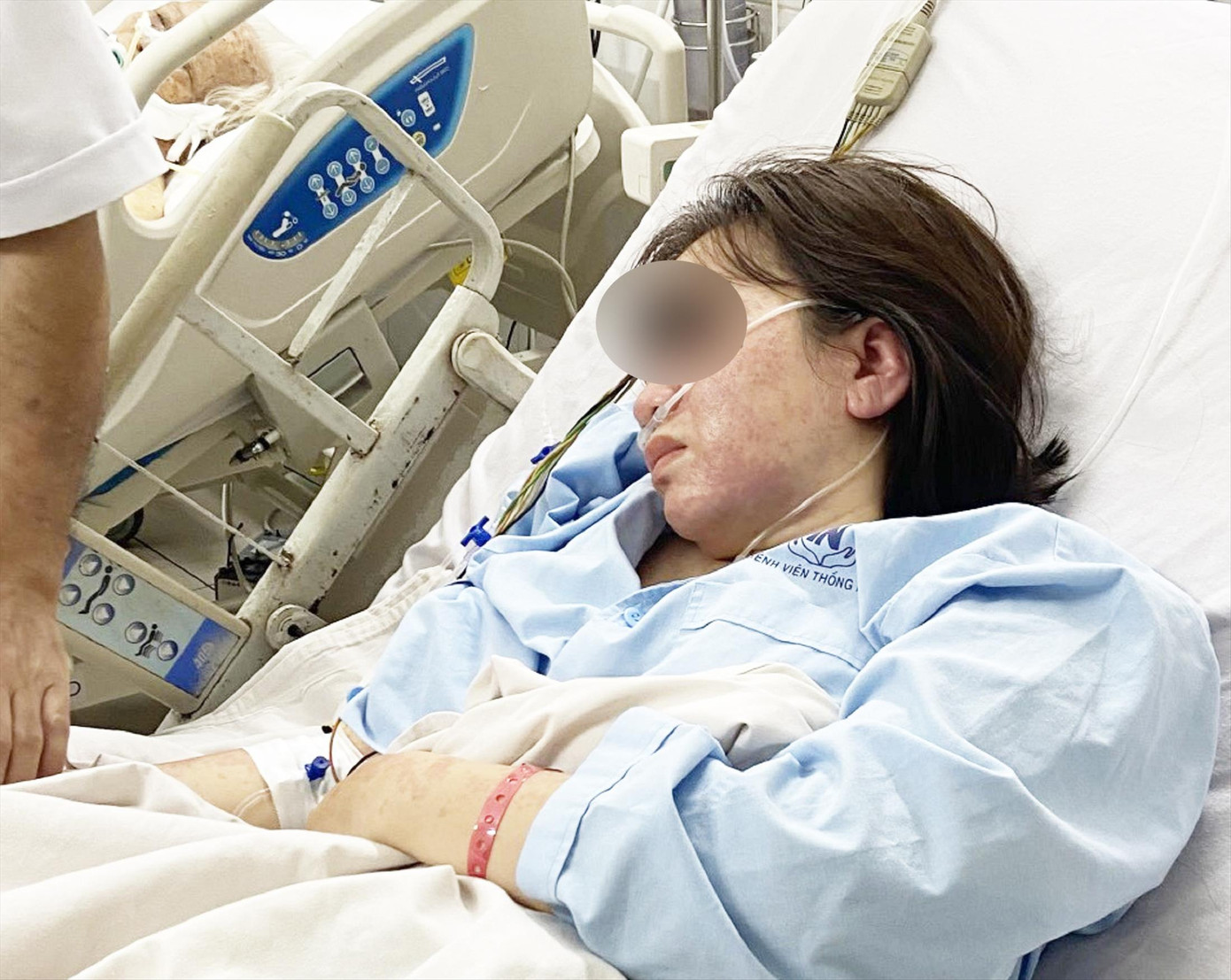 Bệnh nhân bị nổi mẩn đỏ, phù toàn thân, sốc phản vệ độ 3 sau tiêm vắc xin. Ảnh: BVCC Bệnh nhân bị nổi mẩn đỏ, phù toàn thân, sốc phản vệ độ 3 sau tiêm vắc xin. Ảnh: BVCC