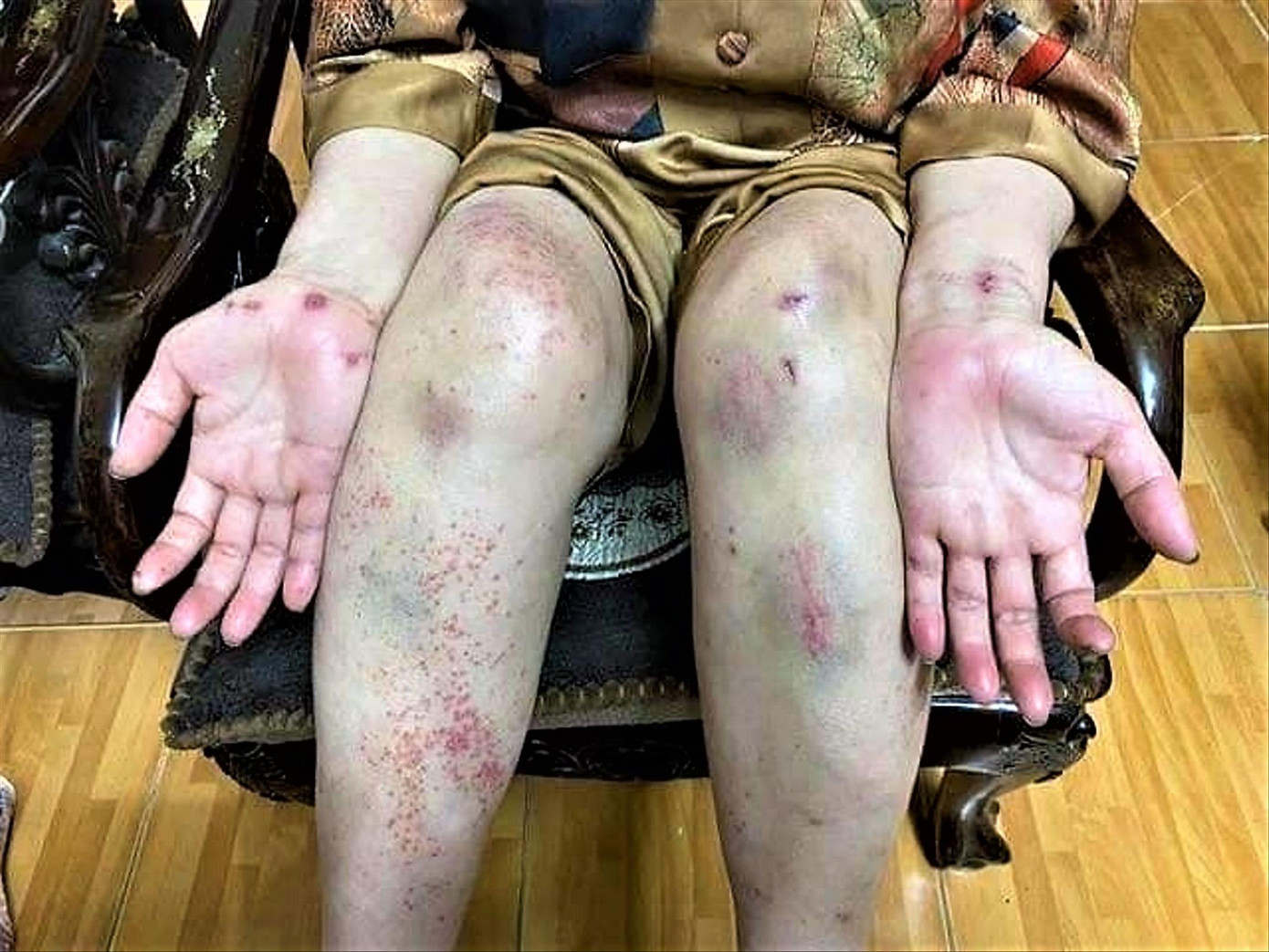 Thân thể bà Liên đầy vết trầy xước, bầm dập và chi chít vết muỗi, côn trùng cắn Thân thể bà Liên đầy vết trầy xước, bầm dập và chi chít vết muỗi, côn trùng cắn