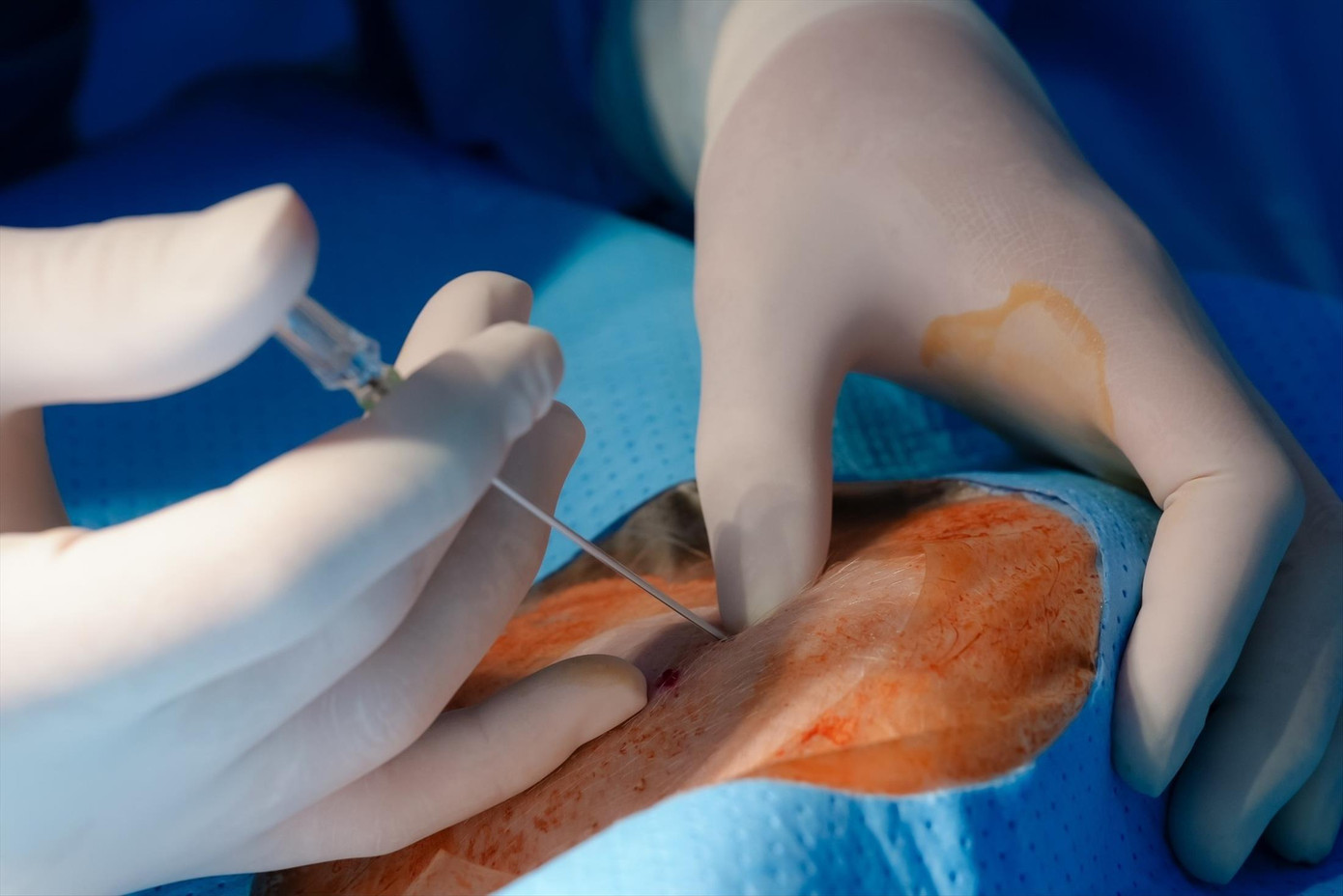 Nguyên nhân dẫn tới tử vong ở người bệnh được chẩn đoán là do ngộ độc thuốc tê (ảnh minh họa)