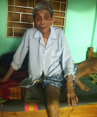 Ông Hai - sau gần 10 năm tự mổ lấy sỏi thận