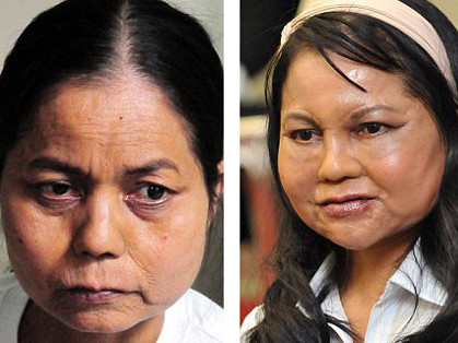 Chị Ngọc Mai trước và sau khi phẫu thuật (từ trái sang). Chị Ngọc Mai trước và sau khi phẫu thuật (từ trái sang)