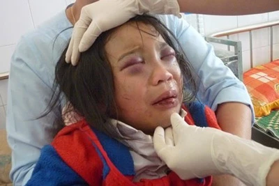 Những vết đánh đập quá nặng nề trên gương mặt cháu Phi 