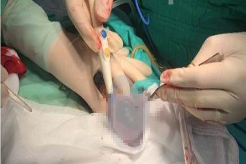 Bệnh nhân phải cắt bỏ một bên tinh hoàn do bị bò đá. Ảnh: BV